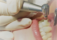 岡崎市 のじまデンタルクリニック 予防歯科